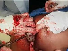 Hospital staff remove a stuck dildo from a man's asshole.